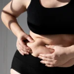 TUMMY TUCK